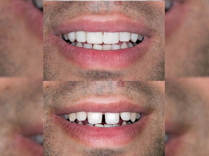 disenos de sonrisa economicos en fusagasuga