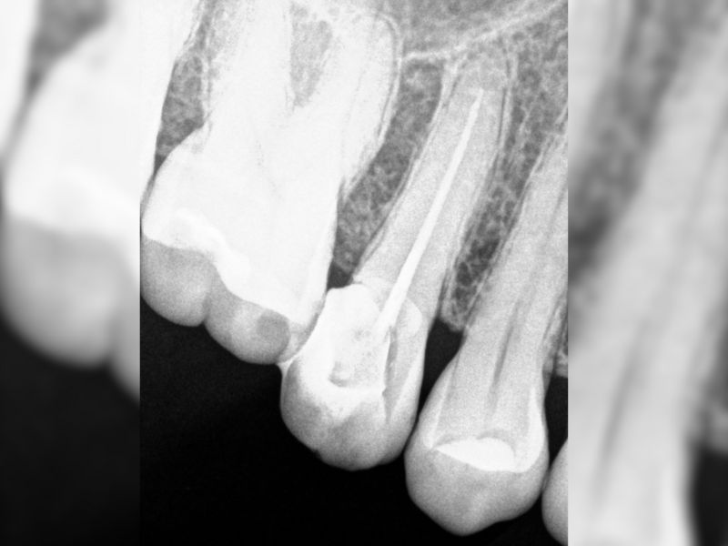 endodoncia dental en fusagasuga