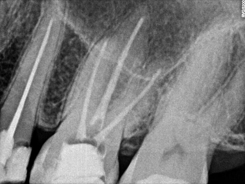 endodoncia fusagasuga