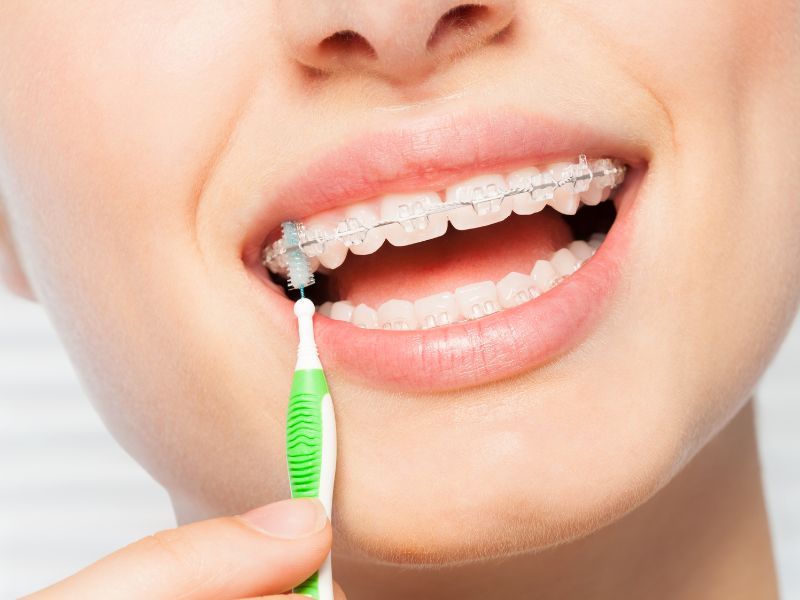 ortodoncia invisible en fusacatan