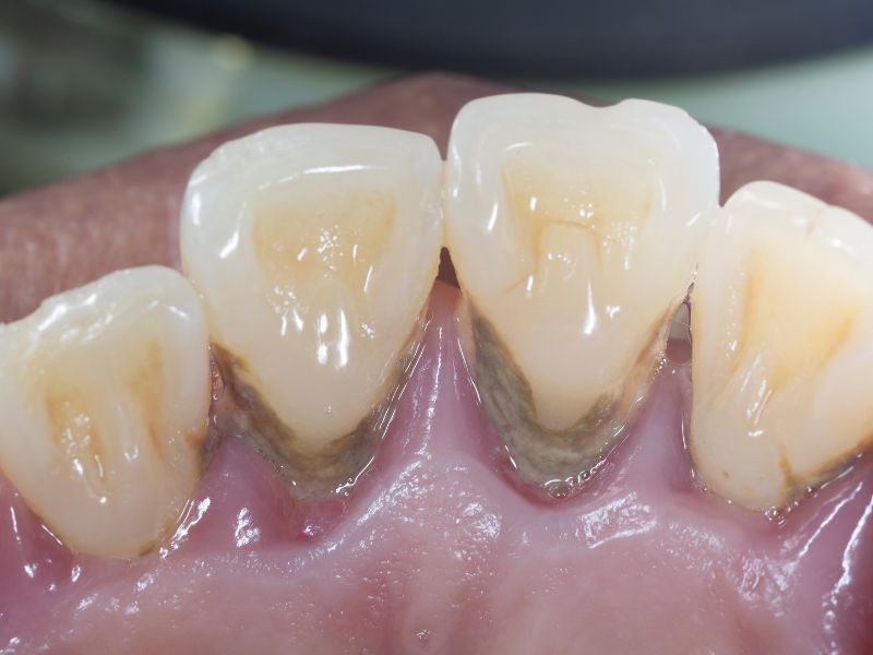 endodoncia fusagasuga