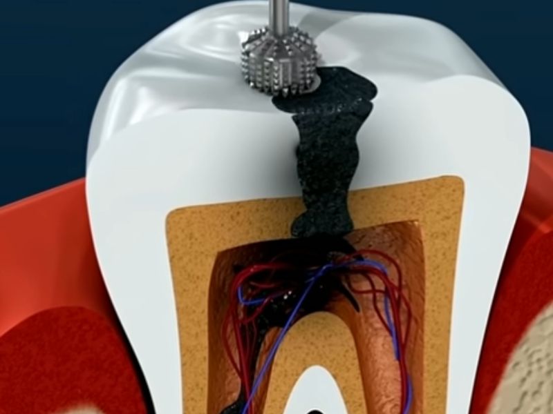 servicios de endodoncia en fusagasuga